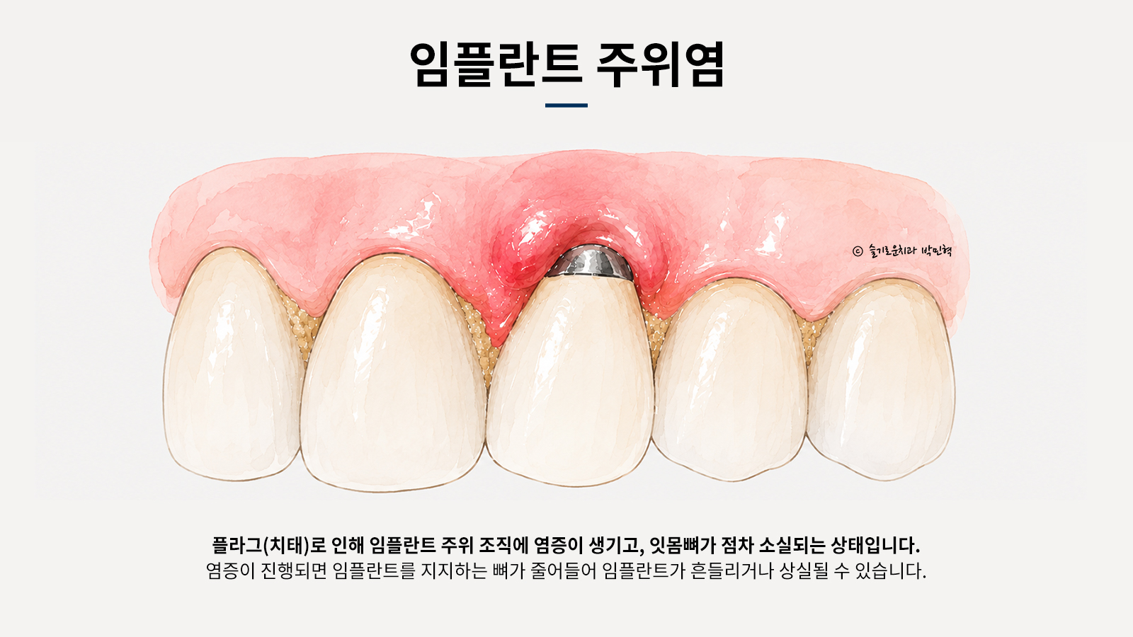 임플란트 주위염 — 앞니 사이에 심은 임플란트 하나만 주변 잇몸이 붉게 붓고 잇몸뼈가 내려앉은 단면 일러스트