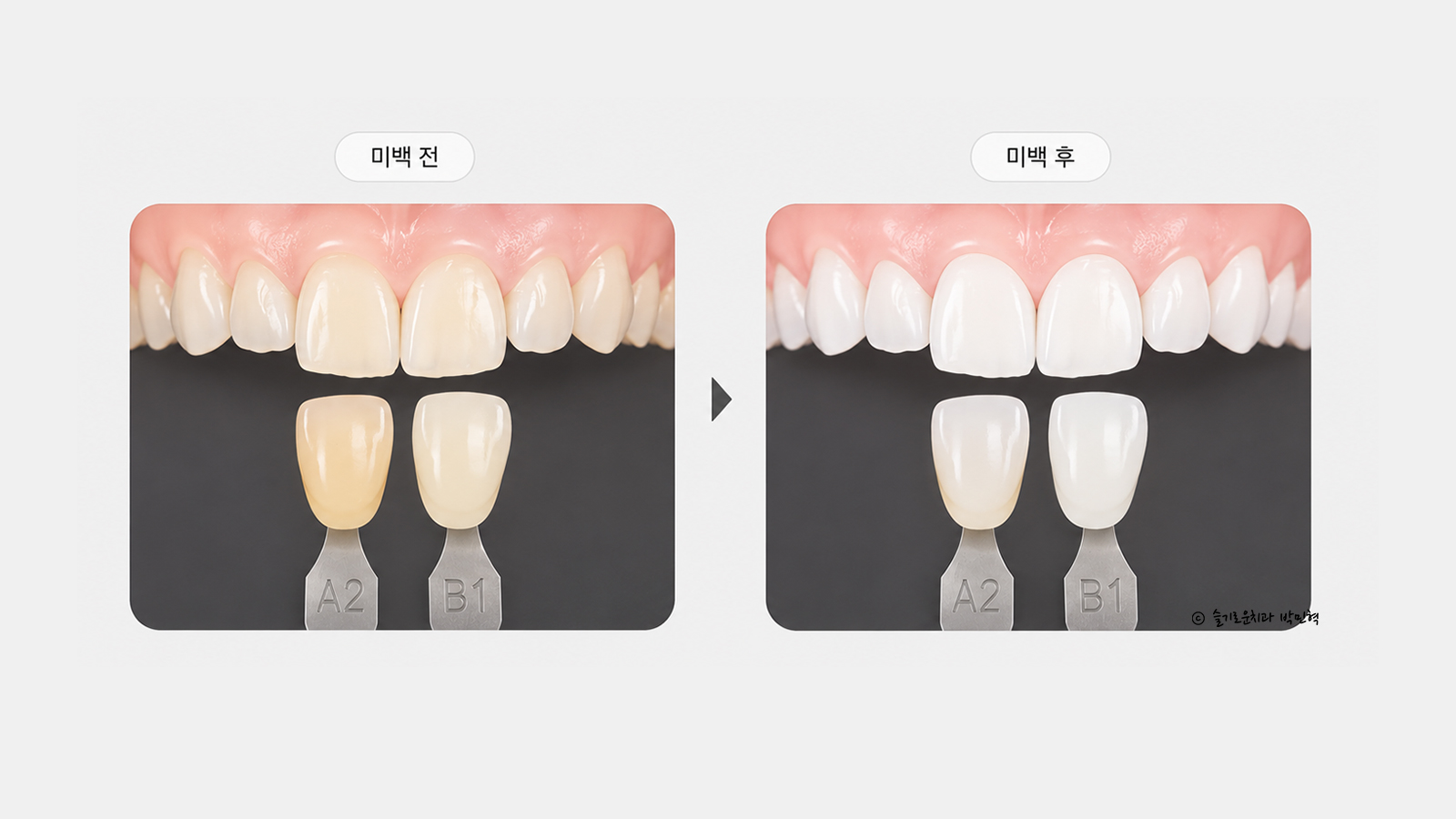 치과 미백 전과 후의 색 단계 비교