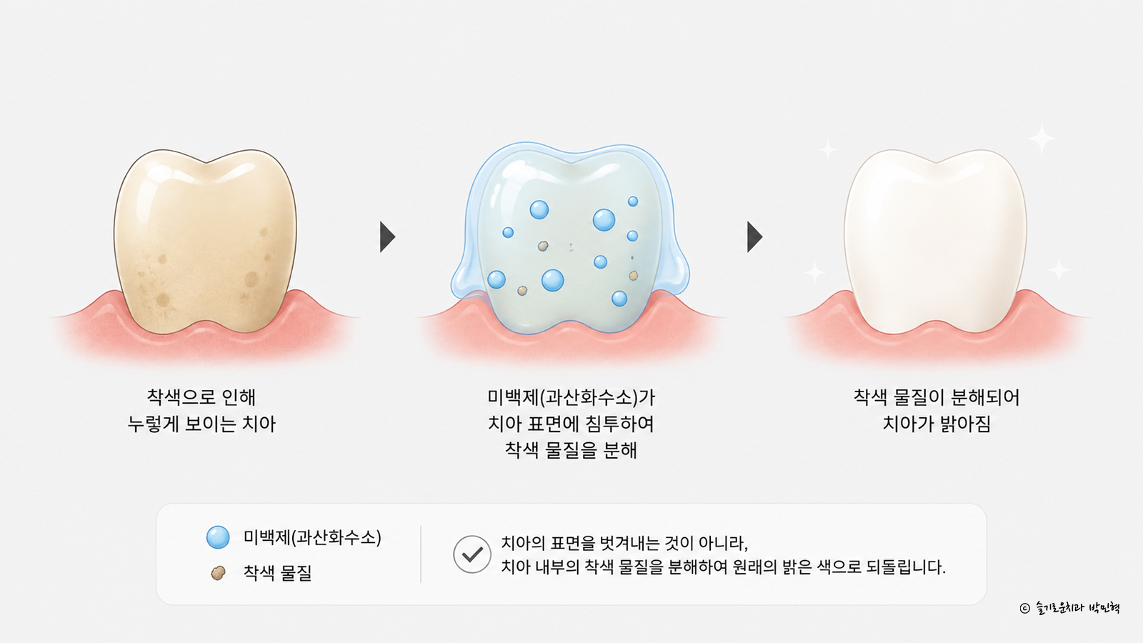 미백제가 치아 속 색소를 분해하는 원리와 진행 과정