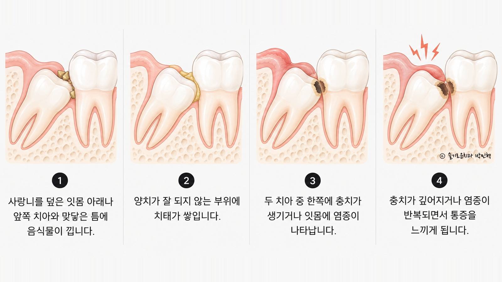 사랑니 옆 어금니에 문제가 생기는 네 단계를 그린 그림 — 음식물이 끼고, 치태가 쌓이고, 충치나 잇몸 염증이 생기고, 통증을 느끼게 되는 순서