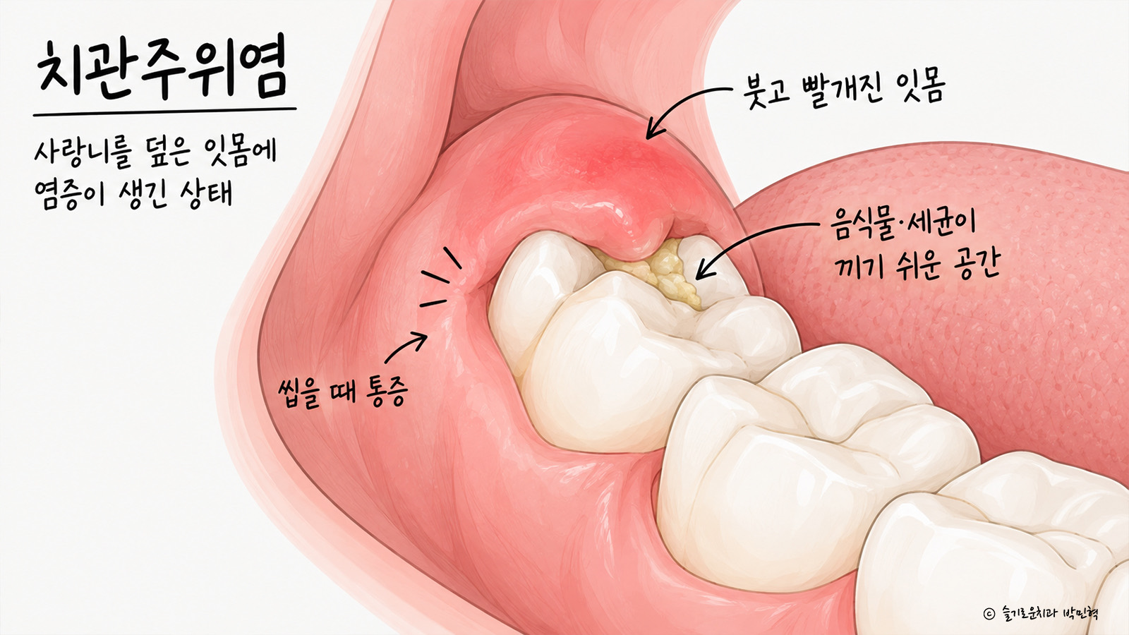 사랑니를 덮은 잇몸에 염증이 생긴 치관주위염 그림 — 붓고 빨개진 잇몸, 음식물과 세균이 끼기 쉬운 공간, 씹을 때 통증을 표시했다