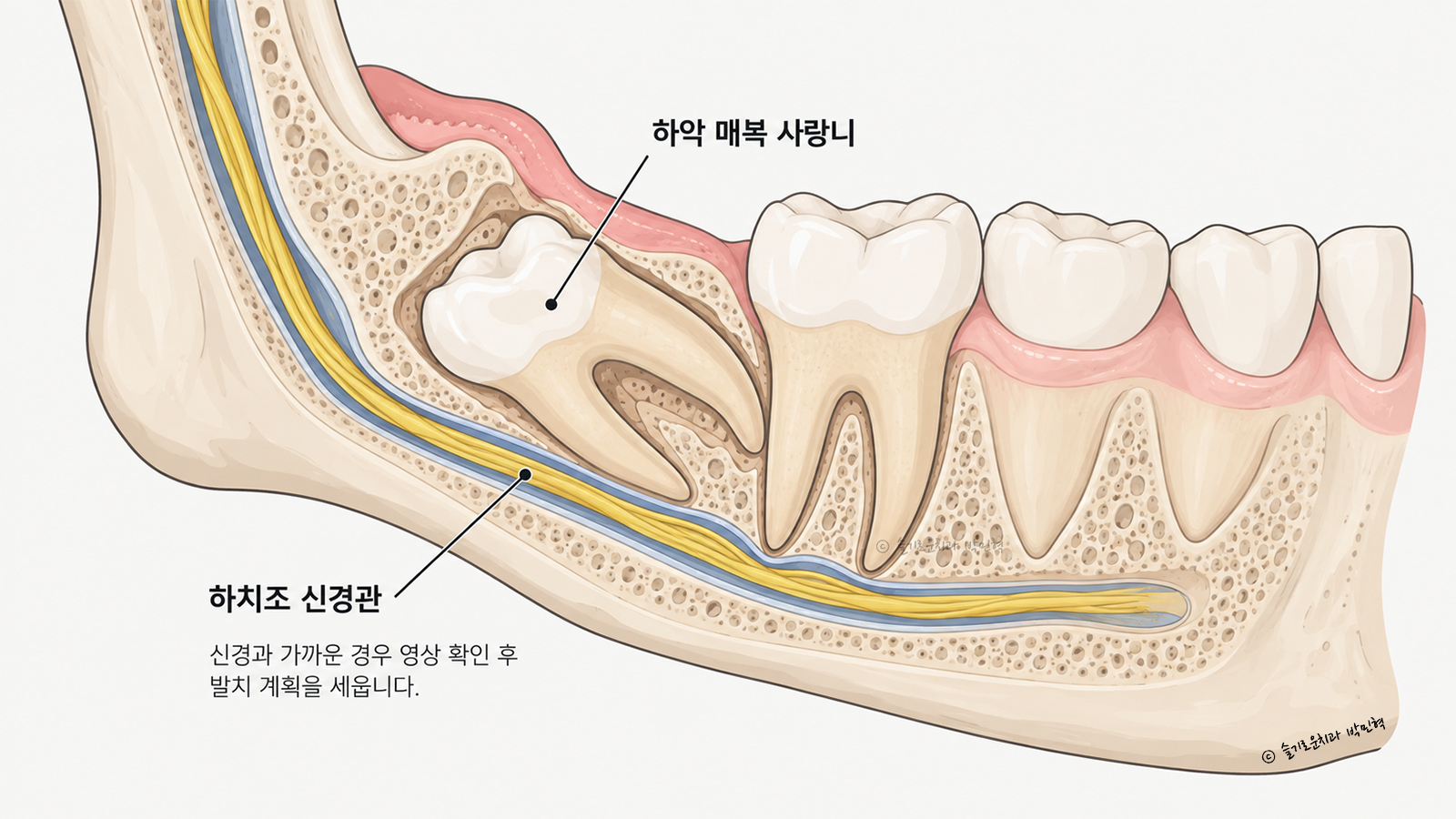 하악 매복 사랑니 뿌리 아래로 하치조 신경관이 지나가는 모습을 그린 아래턱 단면 그림