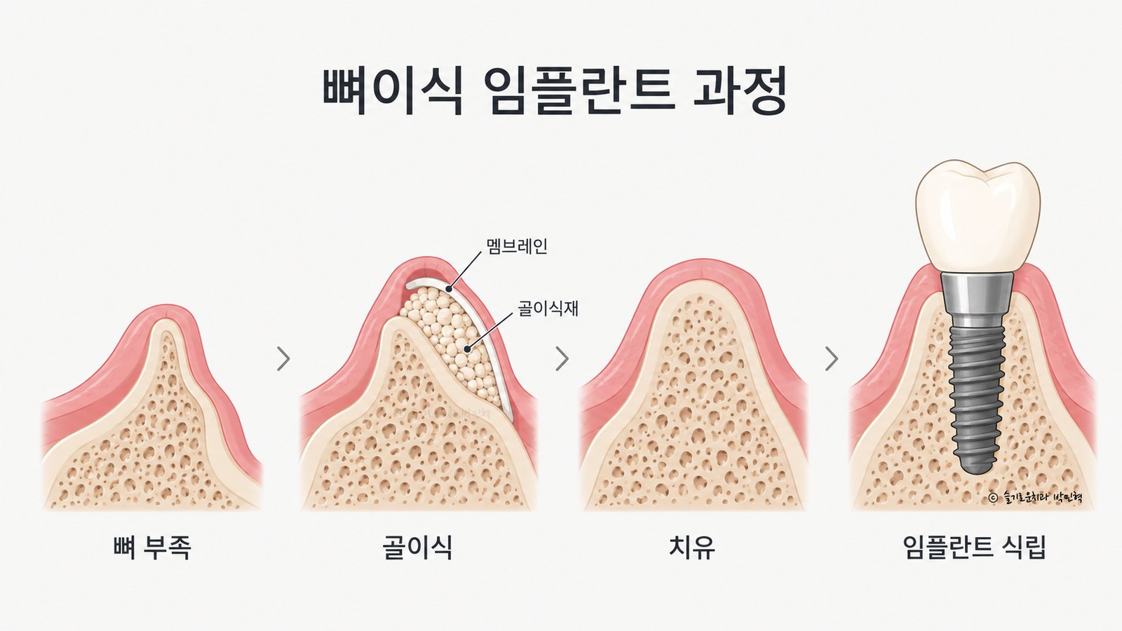 뼈이식 임플란트 과정을 네 단계로 그린 그림 — 뼈가 부족한 자리, 멤브레인 아래에 골이식재를 채운 골이식, 뼈가 차오른 치유, 그 자리에 임플란트를 심은 모습