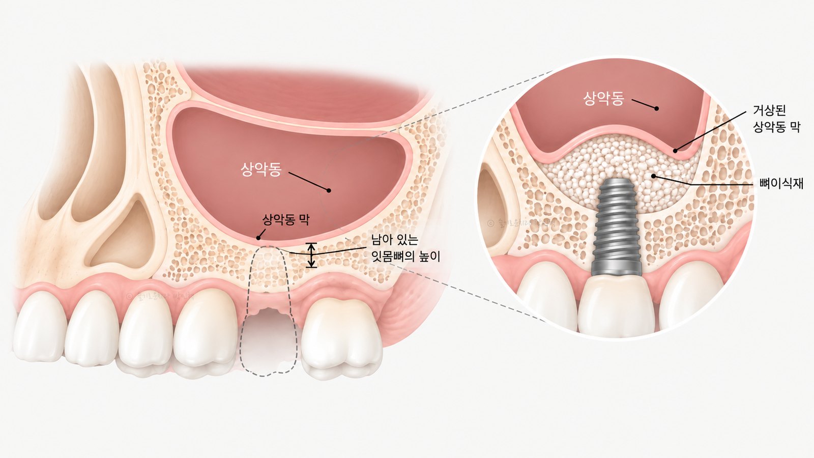 위 어금니 임플란트 단면 그림 — 상악동과 상악동 막, 남아 있는 잇몸뼈의 높이를 표시하고, 오른쪽 확대 그림에 막을 들어 올린 뒤 뼈이식재를 채우고 임플란트를 심은 모습