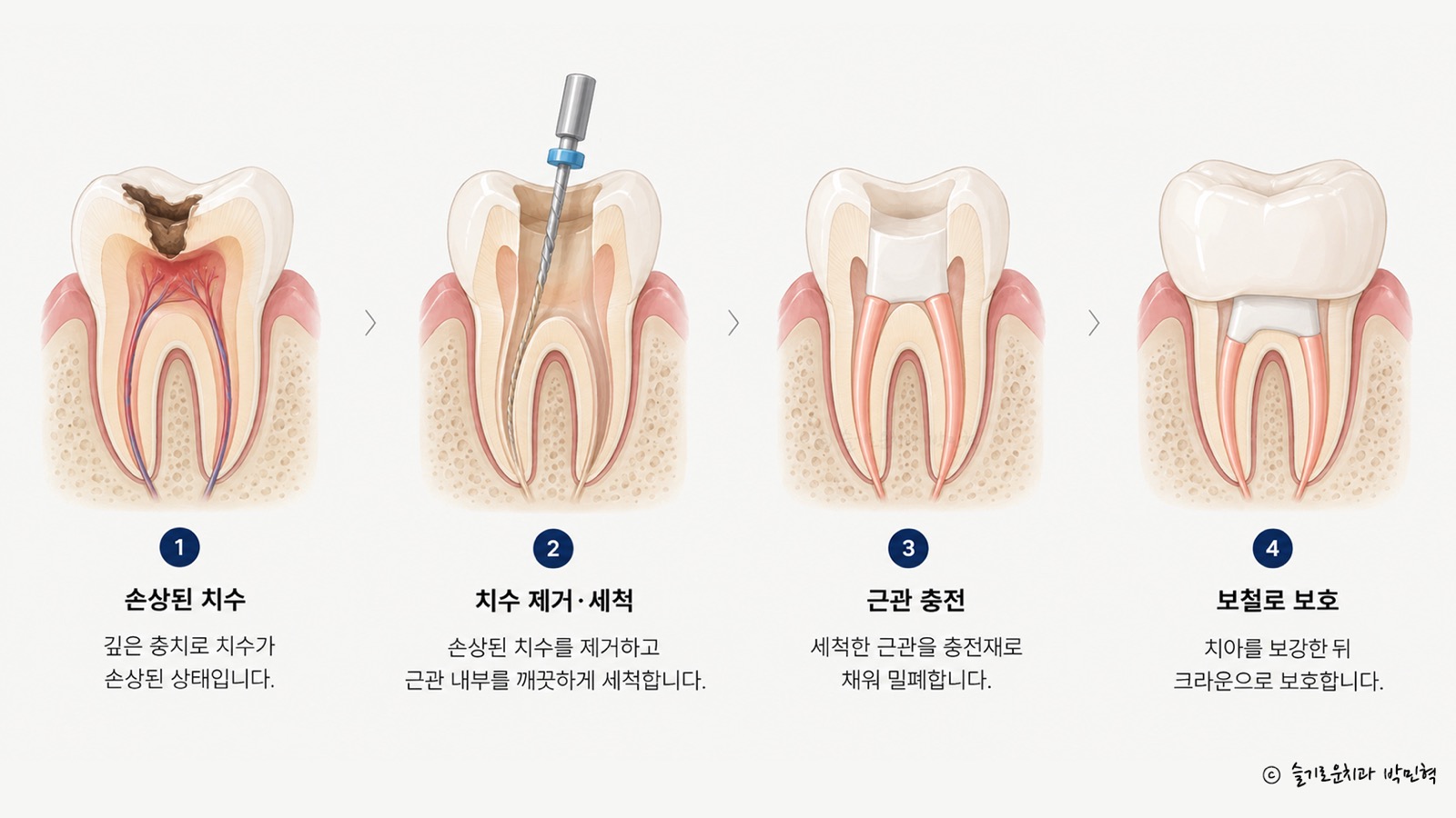 손상된 치수, 치수 제거와 세척, 근관 충전, 크라운으로 보호하는 신경치료 네 단계를 차례로 그린 그림